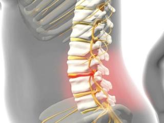 الكشف عن العوامل الوراثية المرتبطة بـ«الانزلاق الغضروفي»