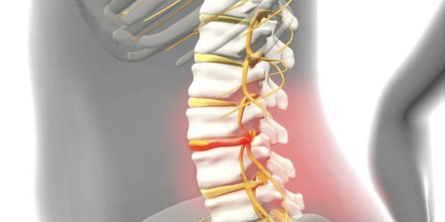 الكشف عن العوامل الوراثية المرتبطة بـ«الانزلاق الغضروفي»